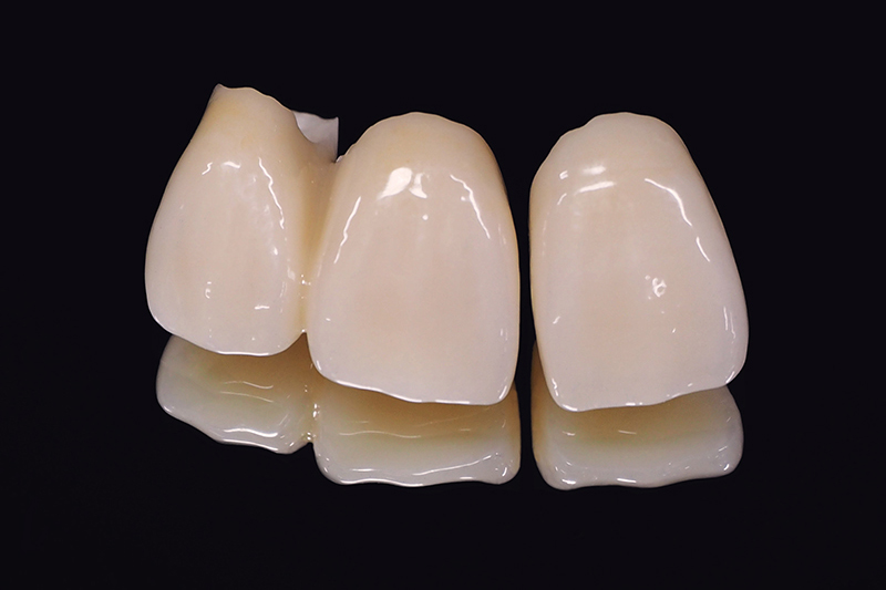 オールセラミッククラウン