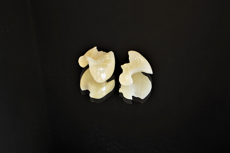 セラミックインレー・オンレー