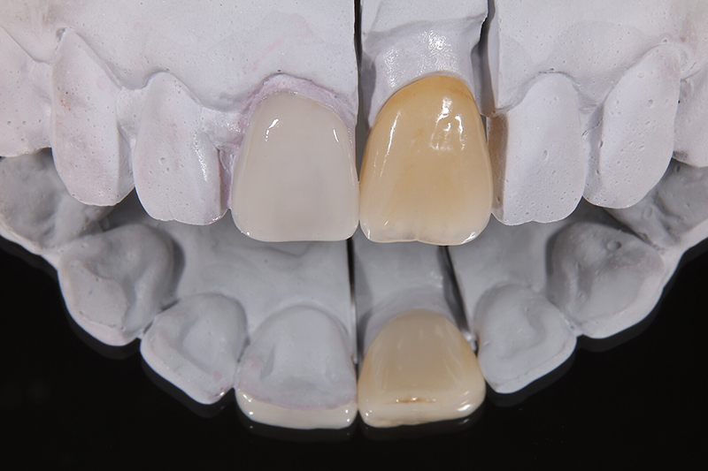 ラミネートベニア