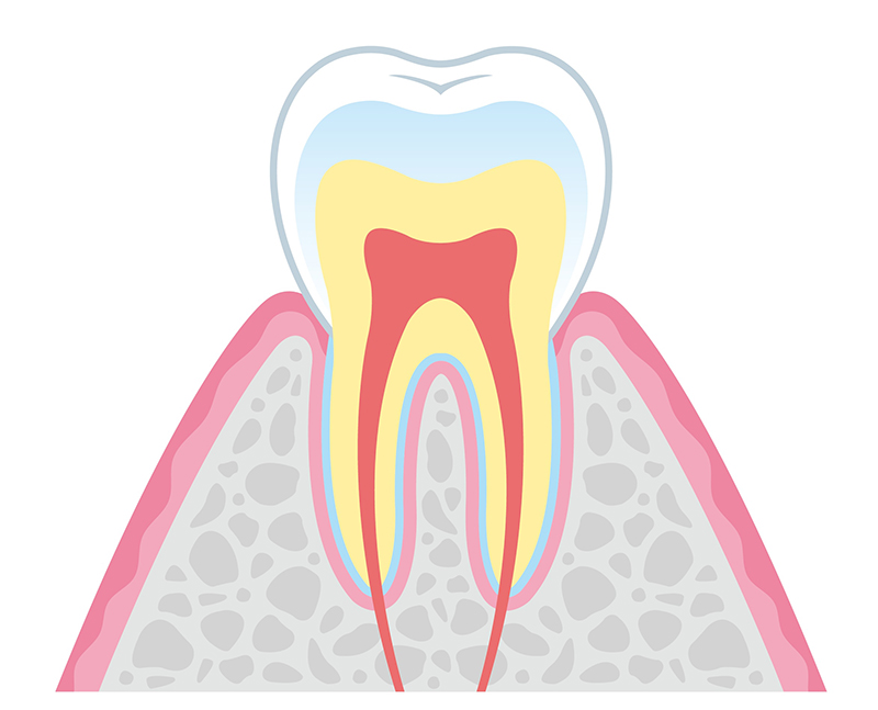 むし歯の進行段階と治療法