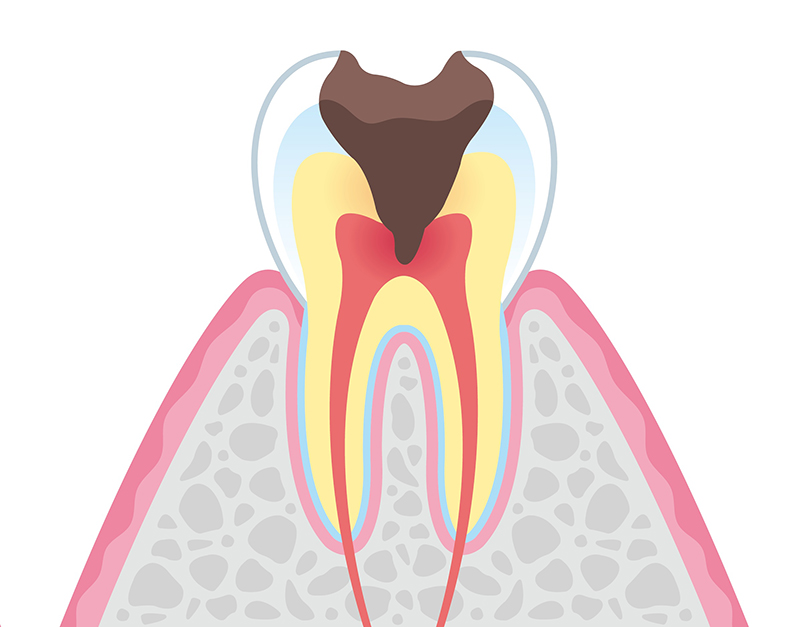 むし歯の進行段階と治療法