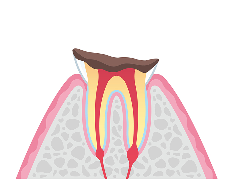 むし歯の進行段階と治療法